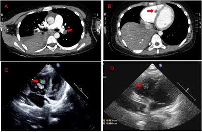 Case Report: Cardiac Multiple Thrombus and Pulmonary Embolism Associated With Mycoplasma Pneumonia Infection in a Child